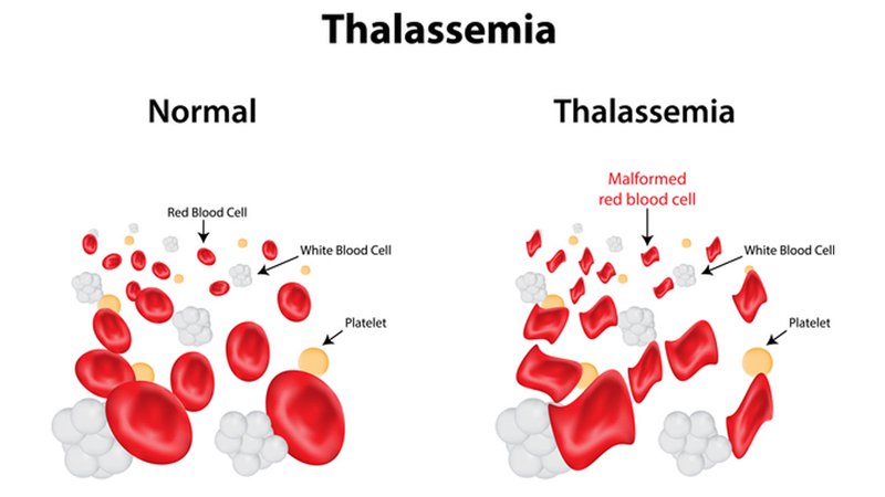 Thalassemia di truyền như thế nào? | Vinmec