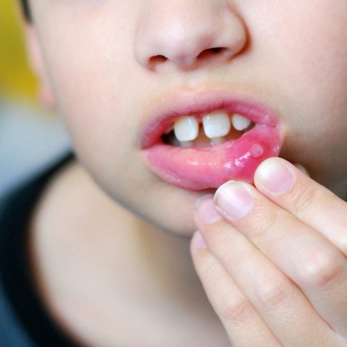 Loét miệng ở trẻ em thường kéo dài 1-2 tuần mới khỏi, những vết loét nhỏ đường kính 1-3mm