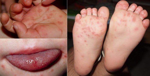 trẻ bị sốt nổi mẩn trên người coi chừng bệnh tay chân miệng