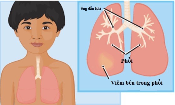 Viêm phổi là một trong những bệnh thường gặp ở trẻ em và là một trong những nguyên nhân hàng đầu gây tử vong ở trẻ nhỏ