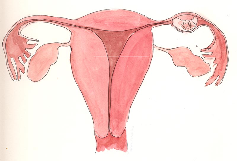 Tắc vòi trứng dẫn đến mang thai ngoài tử cung