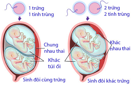 Sự hình thành của thai đôi cùng trứng và khác trứng