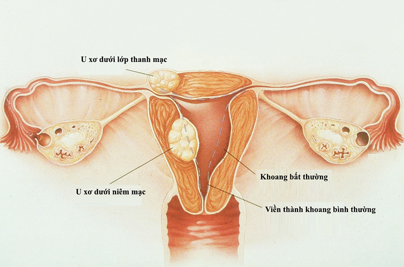 U xơ tử cung có tỷ lệ mắc cao ở phụ nữ bước vào giai đoạn tiền mãn kinh