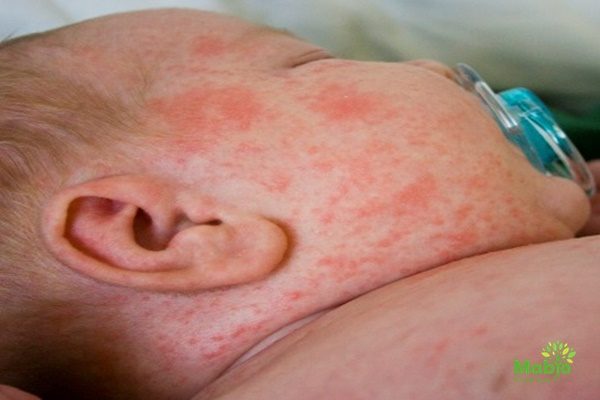 Trẻ sơ sinh bị nổi mụn, mẩn đỏ – Dấu hiệu 6 bệnh ngoài da phổ biến