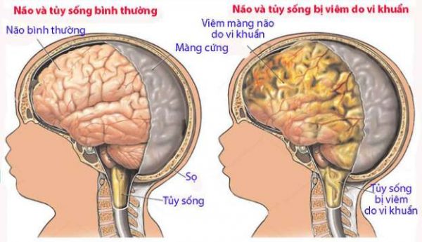 Viêm màng não là bệnh gì ? Viêm màng não ở trẻ em có nguy hiểm không?