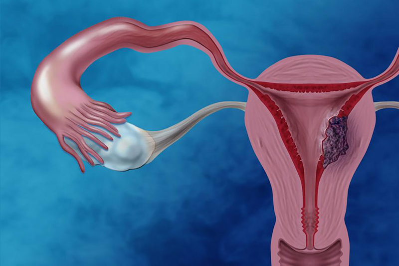 Hình ảnh minh họa khi bị u nang buồng trứng
