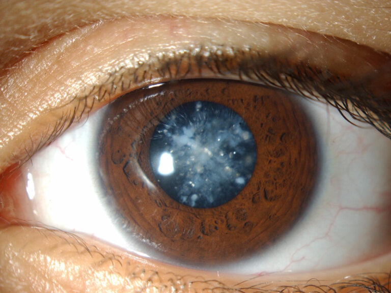 Hiểu đúng về bệnh đau mắt trắng ở trẻ