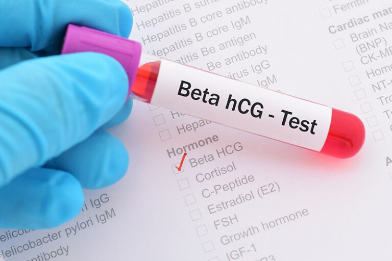 Tìm hiểu ý nghĩa của xét nghiệm beta hCG trong chẩn đoán chửa trứng