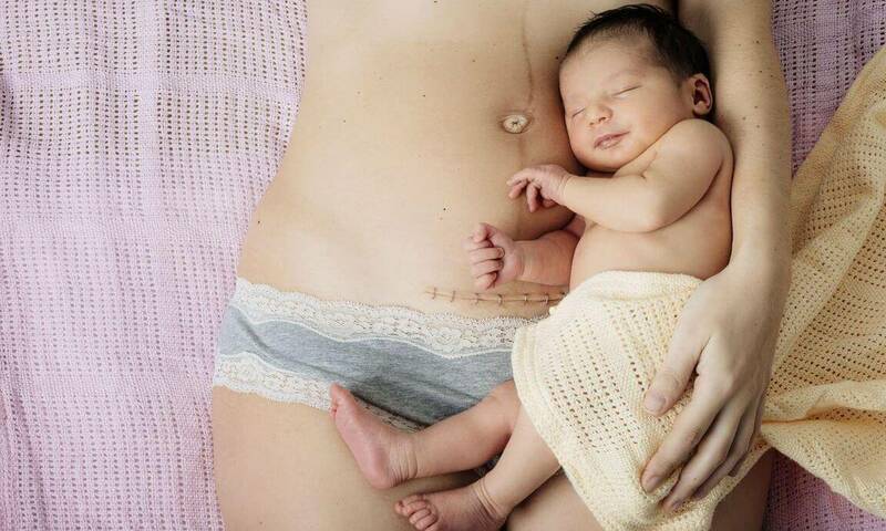 Sinh mổ bao lâu thì được nằm sấp là thắc mắc của rất nhiều mẹ bỉm sữa